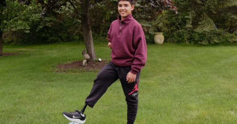 Fitted for a prosthetic leg in Flint, a boy from Gaza can chase his dreams again