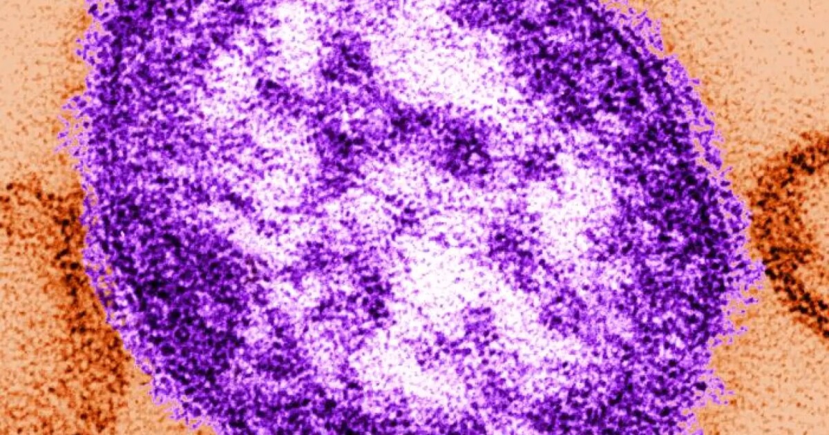 Ottawa County reports measles outbreak but says it's limited to one household
